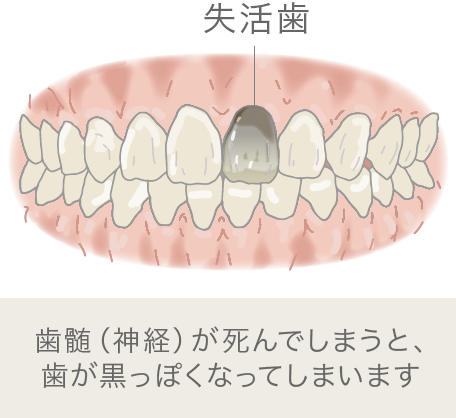 失活歯